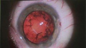 Cataract surgery explained step by step