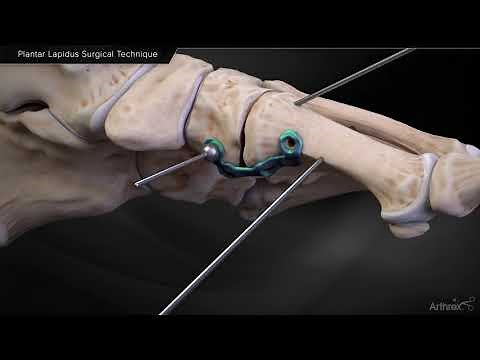 Plantar Lapidus Surgical Technique
