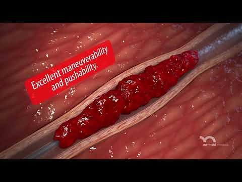 D-Clot HD Mechanical Thrombectomy System