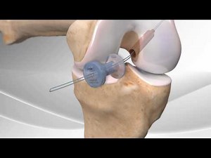 ACL Reconstruction with Arthrex® GraftLink®