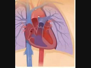 DVT -Pulmonary Embolism