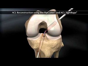 ACL Reconstruction using the FlipCutter and ACL TightRope