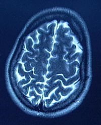 Magnetic Resonance Imaging (MRI) - Head