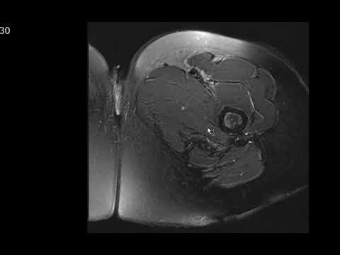 MRI HIP TUTORIAL