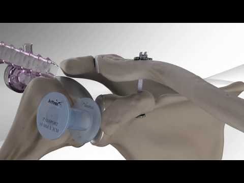 AC Joint Repair with Arthrex® Dog Bone™ Button