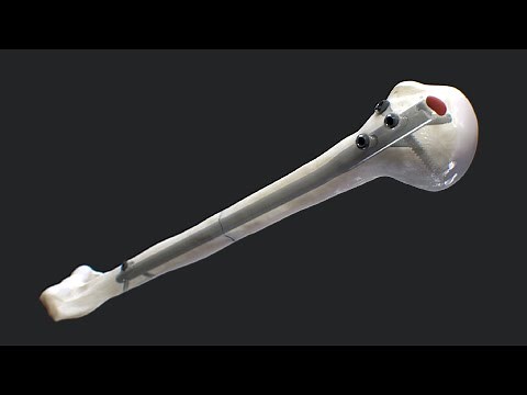 Long Humeral Nail System Surgical Technique