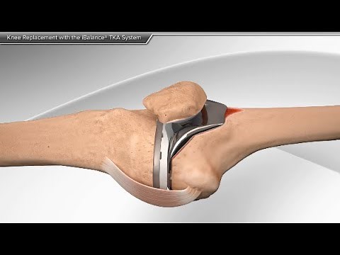 Knee Replacement with the iBalance TKA System