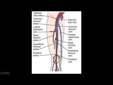 Lower Extremity Deep Venous Thrombosis (DVT)